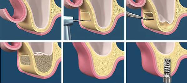 начало процедуры имплантации зубов